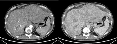 Low-dose PD-1 inhibitor combined with lenvatinib for preemptive treatment of recurrence after liver transplantation for hepatocellular carcinoma: Case report and literature review